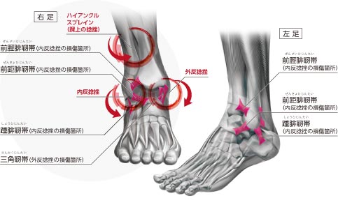 捻挫 サポーター 足首