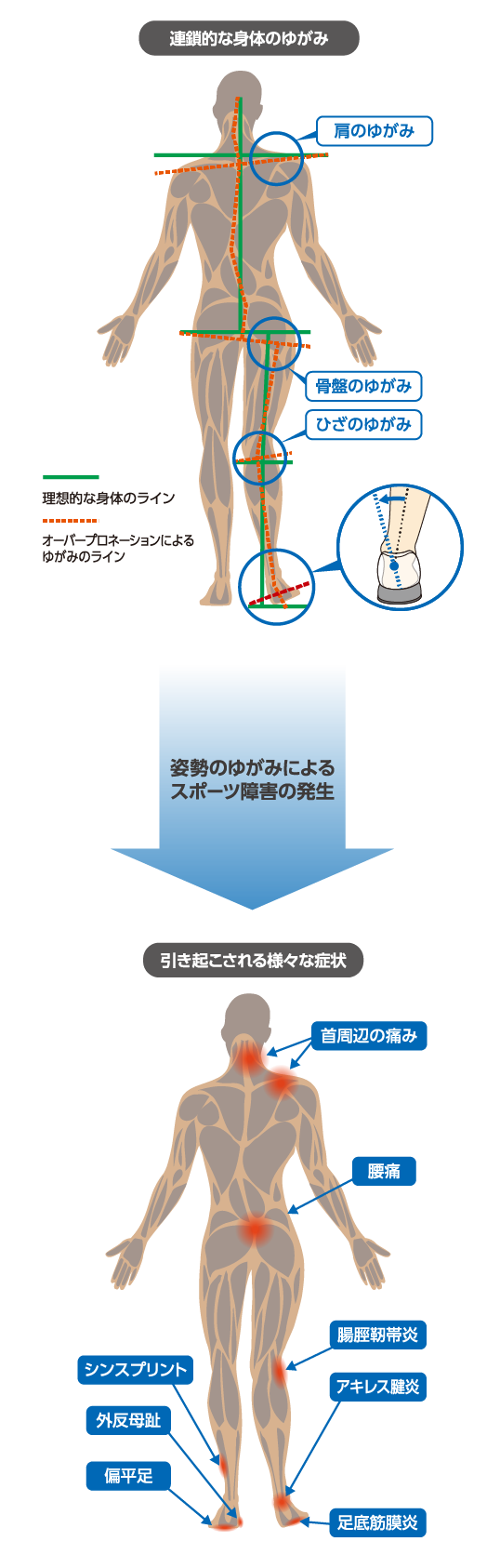 オーバープロネーション（過回内）による姿勢の崩れ