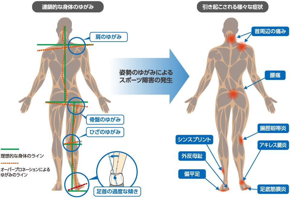 オーバープロネーション（過回内）による姿勢の崩れ